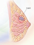 冬虫夏草对乳腺癌细胞的抑制作用